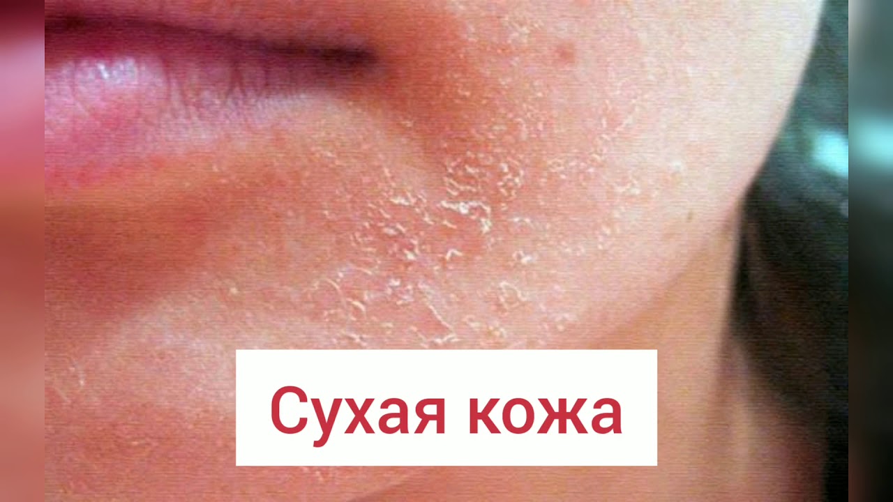 Фотодинамическая терапия - YouTube