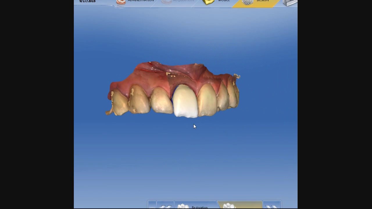 Fabrication of a ceramic crown in one hour using CEREC CAD/CAM ...