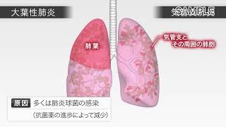 目で見る病気 第3版　VOL.10 呼吸器系の疾患（肺炎）