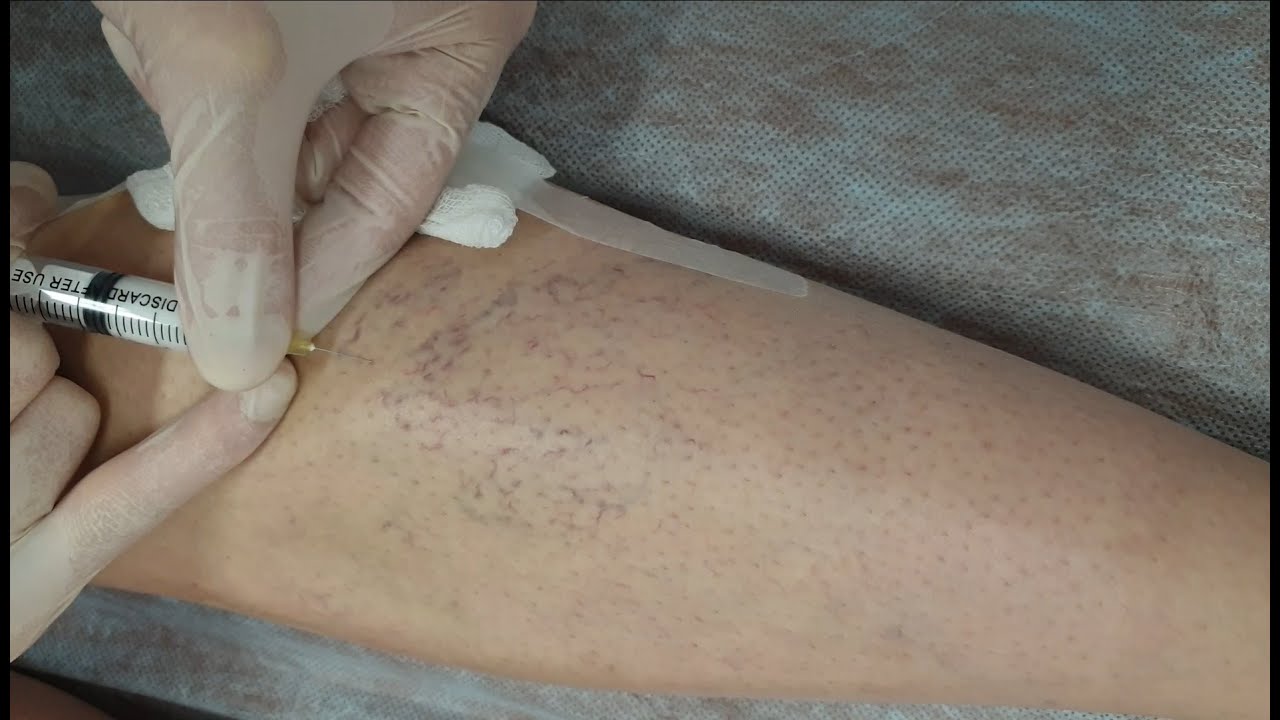 Склеротерапия. Как избавиться от нежелательных вен и сосудистых ...