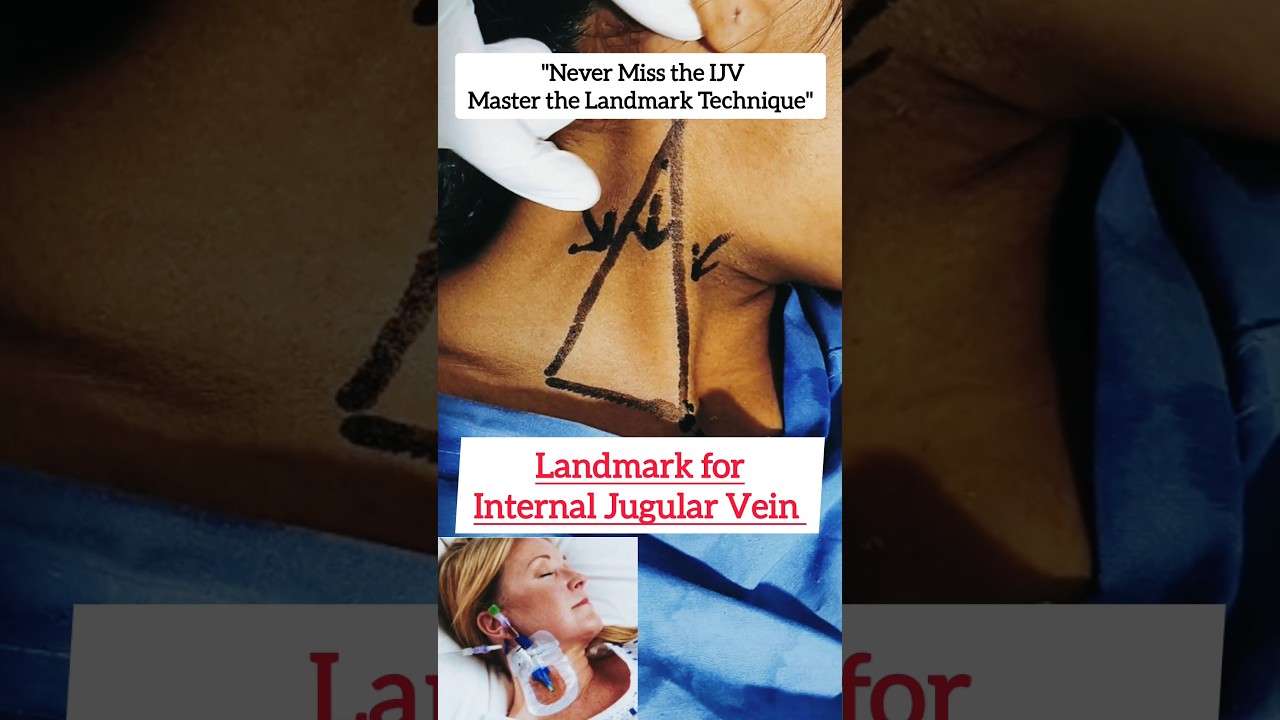 Landmark for Internal Jugular Vein Central Line 