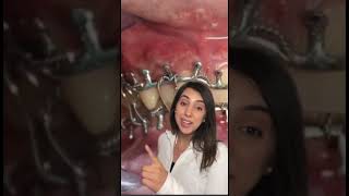 Life after jaw surgery! #dentist #braces #oralsurgeon #smilemakeover #healing