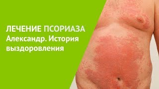 Лечение псориаза. Александр, история выздоровления