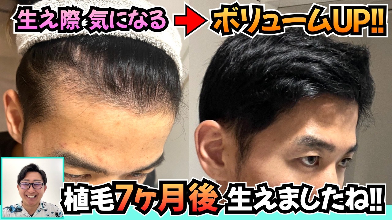 【植毛7ヶ月後】生え際が薄くて気になったので髪ボリュームアップ植毛した【自毛植毛|薄毛対策】