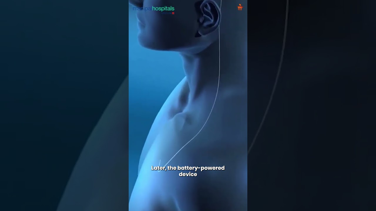 Thumbnail for Understanding Deep Brain Stimulation (DBS) | Dr. Swathy Nair | Manipal Hospital Yeshwanthpur