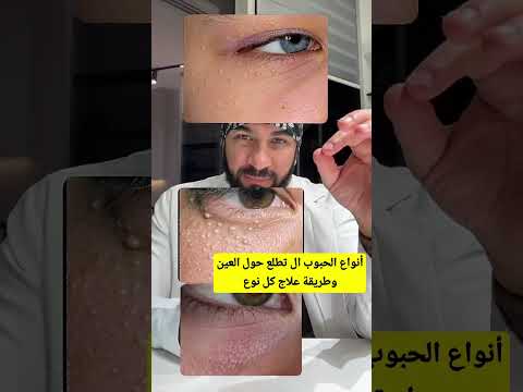 أنواع الحبوب حول العين وعلاج كل نوع بالتفصيل الأسباب وطرق العلاج مع د طلال المحيسن