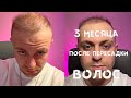 ВОТ И ПЕРВЫЙ РЕЗУЛЬТАТ! 3 месяца после пересадки