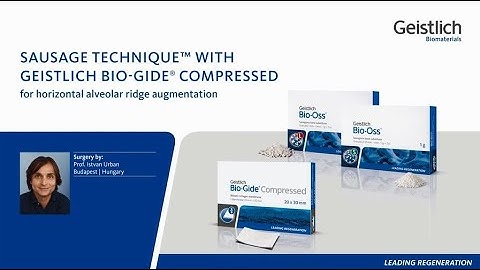 Sausage TechniqueTM with Geistlich Bio-Gide Compressed® for horizontal alveolar ridge augmentation