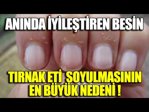 Tırnak Etlerinin Soyulmasının Asıl Belirtisi Olan Hastalık