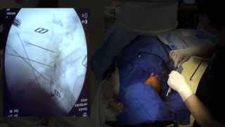 WATCH a Cervical Radiofrequency Ablation - LIVE!