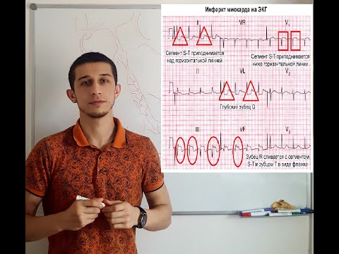 Расшифровка ЭКГ при инфаркте миокарда