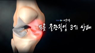 [명의 의학백과📖] 무릎 골관절염 3기 상태
