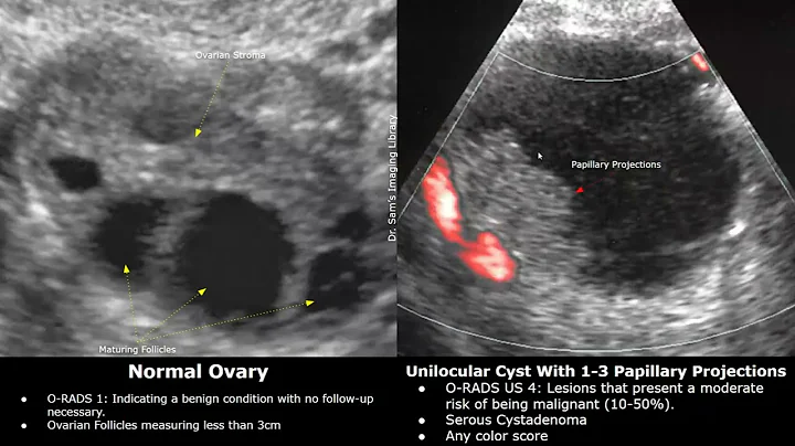 Ovarian-Adnexal Reporting and Data System Ultrasound (O-RADS US) | Classification Of Ovarian Lesions - DayDayNews