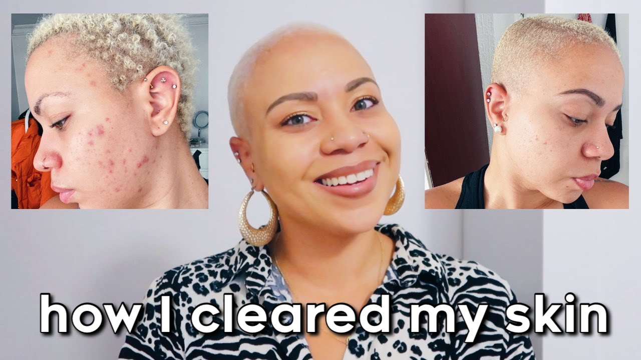 my hormonal acne journey: how I FINALLY cleared my skin for good! - YouTube