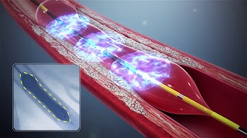 Supplementary Video 1: Shockwave Coronary Intravascular Lithotripsy System