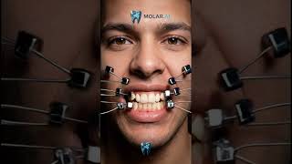 Braces transformation