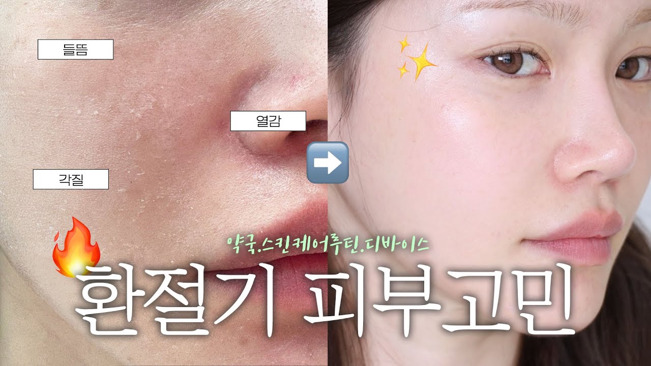 환절기 피부 뒤집어짐🔥바로 회복하는 법!!! 개복치 피부도 일주일만에 꿀피부로 바꿔드림🍯
