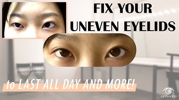 Treatable Cases 4 | Making double eyelids or fixing uneven eyelids with Optifold