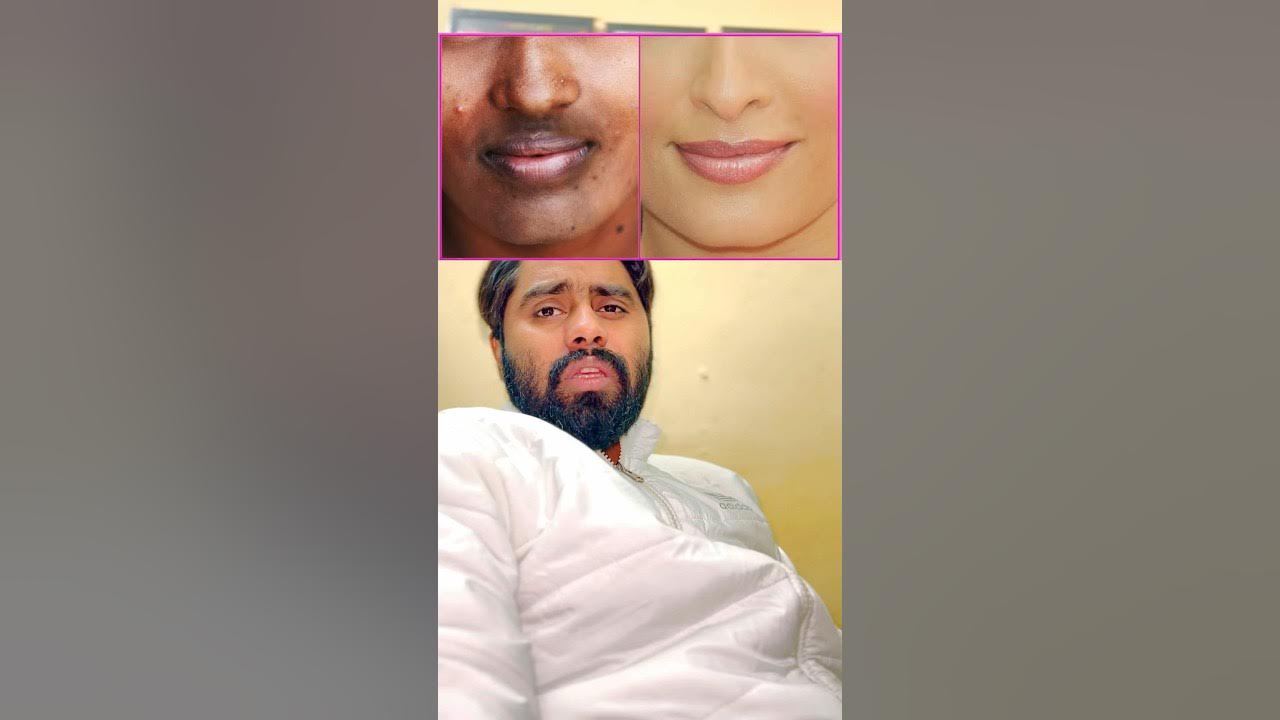 treatment-for-pigmentation-around-mouth-you-have-dark-skin-around