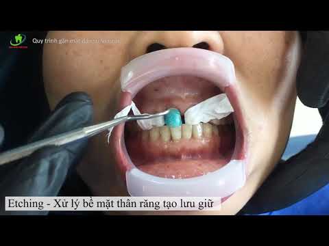 Video: Cách dán veneer: chuẩn bị nguyên liệu và hướng dẫn từng bước