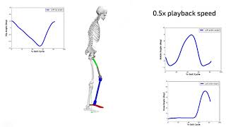 Osseointegrated Amputee Gait Simulation in OpenSim