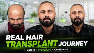 Hair Transplant in India (HX-YYNE) | Best Results & Cost of Hair Transplant in  India