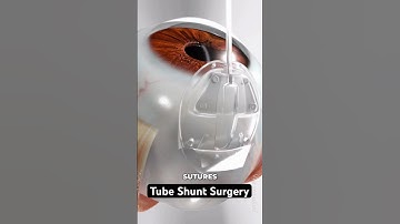 Reducing pressure to prevent vision loss (3D Animation)