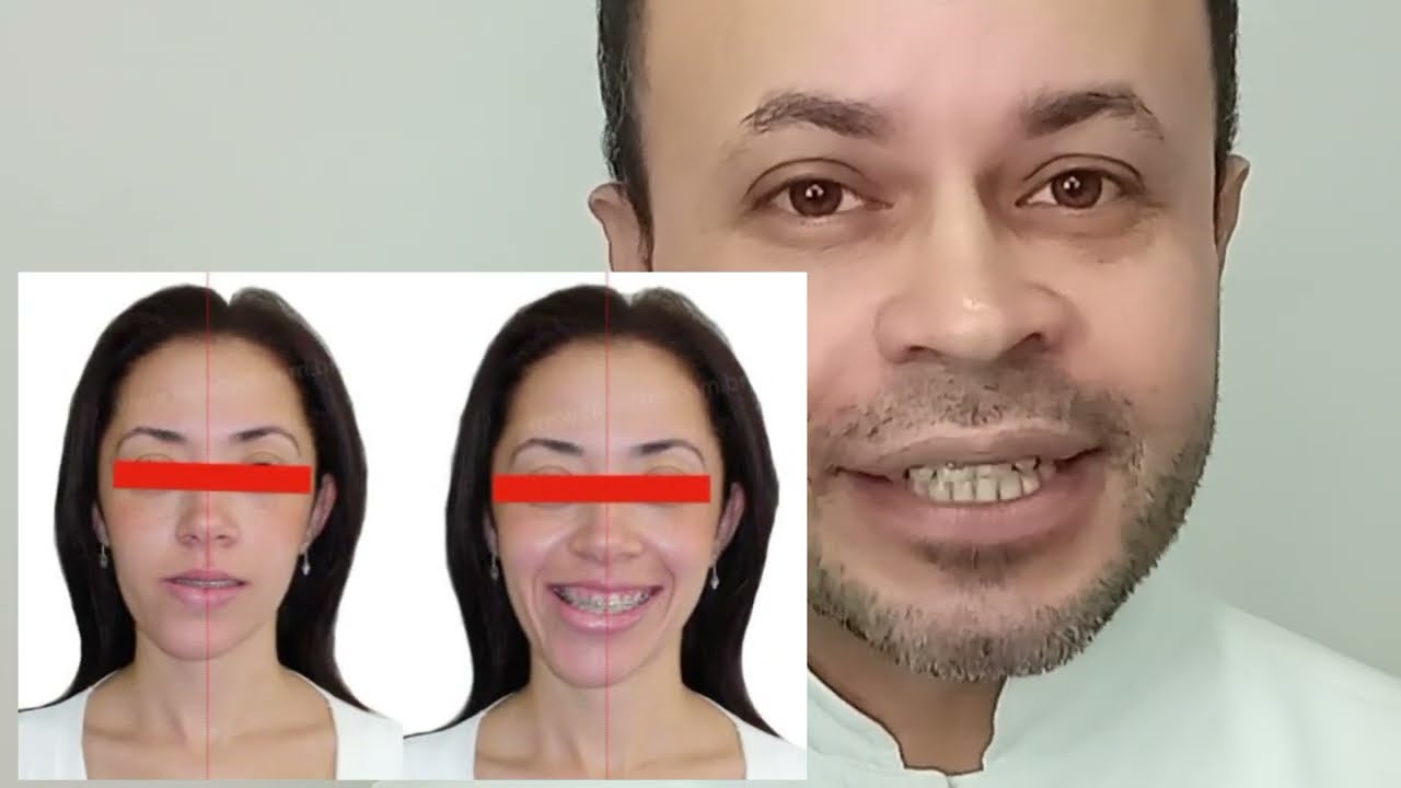Exercícios Simples para Corrigir Assimetria do Rosto – Resultados em Semanas!