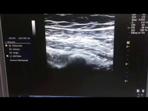 pec block