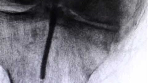 PTA POPLITEAL (C.T.O) & PERONEAL ARTERY