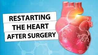 Surgeon Q&A: Restarting the Heart After Cardiac Surgery