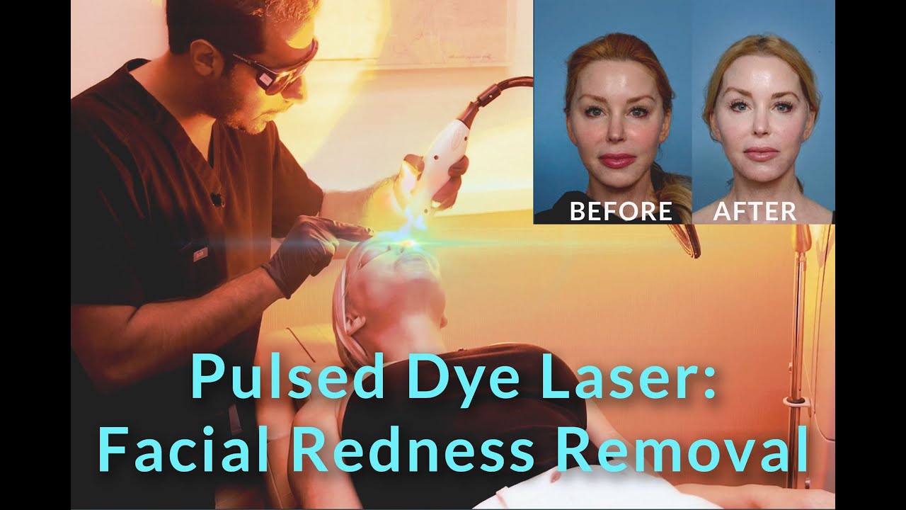 Pulsed Dye Laser Facial Redness Removal with Dr. Sameer Bashey