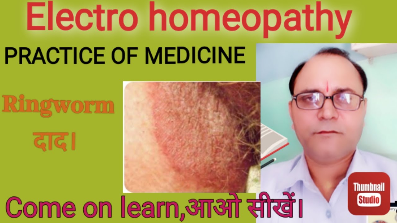ElectroHomeopathy (Practice of Medicine)Ring Worm,fungal infection