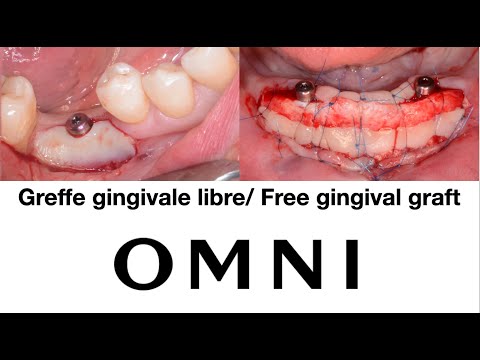 Greffe gingivale libre péri-implantaire