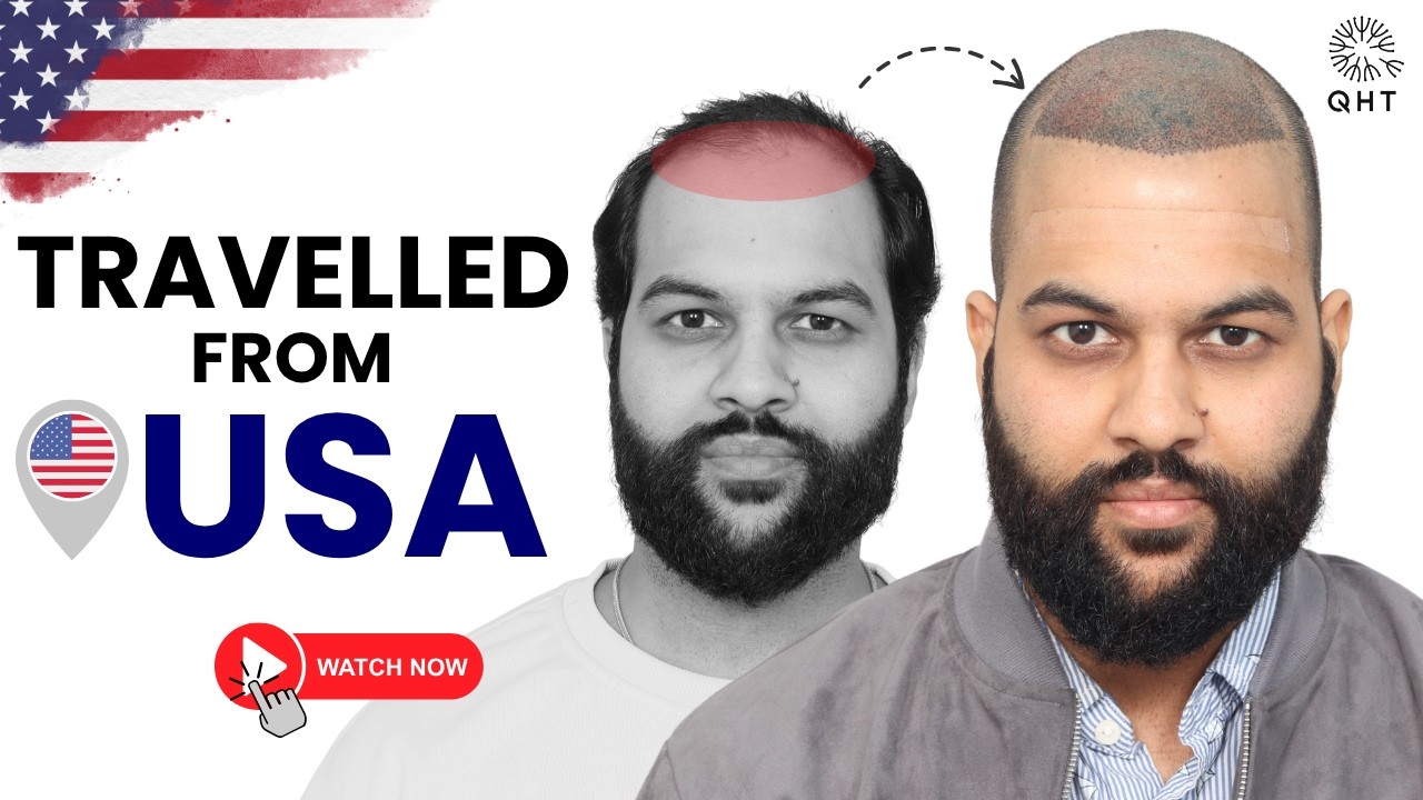 Hair Transplant in India for NRI | USA to India: QHT Clinic | Best Hair Transplant Clinic in India