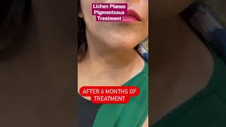 Lichen Planus Pigmentosus Treatment | Dr Ashima Goel #shorts