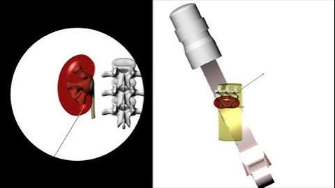 ESUT educational video on fluoroscopic guided puncture in PCNL: All techniques step by step