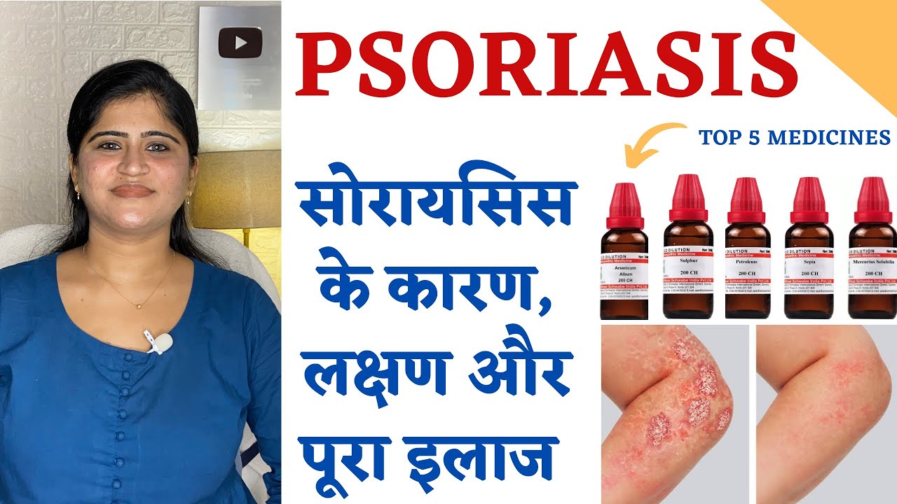 Psoriasis Homeopathic Treatment ॥ सोरायसिस के कारण, लक्षण और पूरा इलाज
