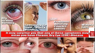 DRY EYE SYNDROME | PATIENT EDUCATION AND INFORMATION | CAUSES, SYMPTOMS, TREATMENT.