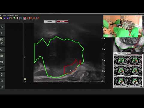 Prostatos biopsija su MRT navigacija lt