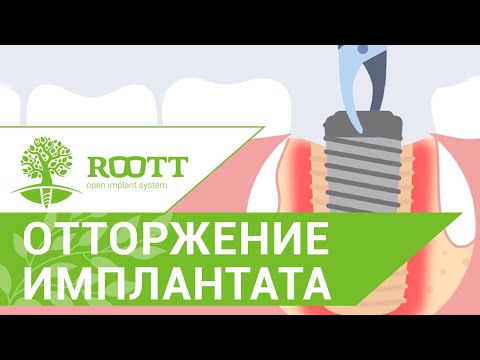 Причины и признаки отторжения импланта. Отторжение импланта. ROOTT
