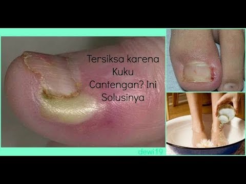 Cara menyingkirkan Kuku kaki tumbuh kedalam