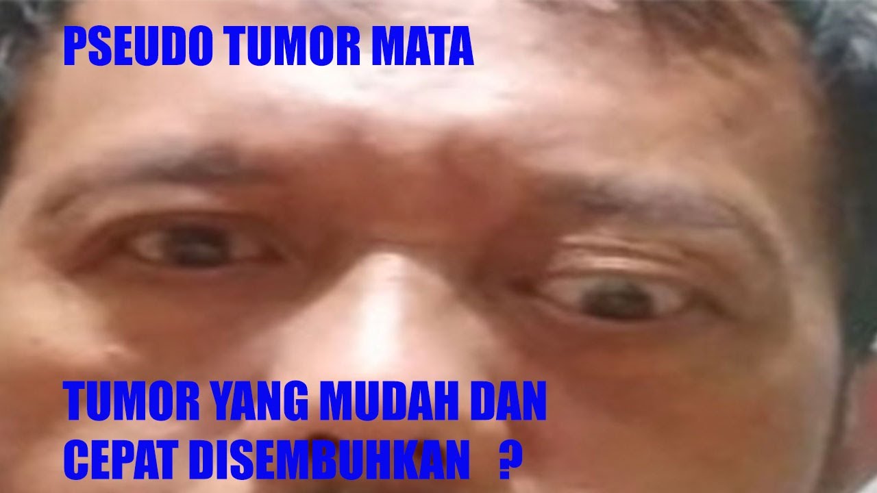 PseudoTumor Mata, tumor yang cepat dan mudah disembuhkan ?