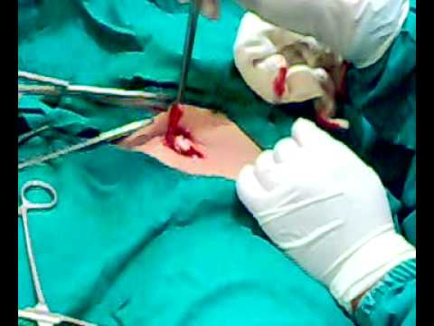 tubal ligation incision