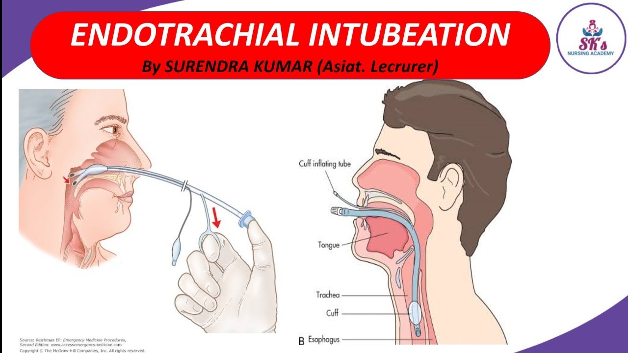 Endotracheal Intubation YouTube