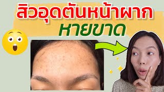 สิวหน้าผากเกิดจากอะไร