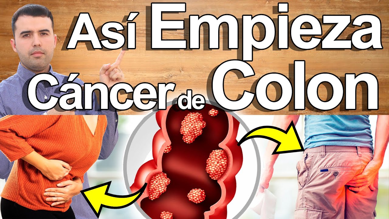 As� Empieza El C�ncer De Colon Y Nadie Lo Sabe - Signos Y S�ntomas de C�ncer Que Debes Conocer