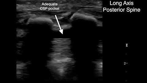 Use #POCUS to end the bloody or "dry tap" Neonatal LP
