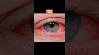 eye flu hone par kya kare | आई फ्लू से कैसे बचें | eye drop | eye flu treatment apnamedicaltips