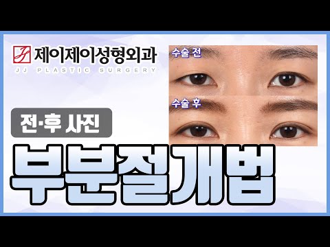 <strong>부분절개</strong> 전후영상 - 제이제이성형외과 #shorts